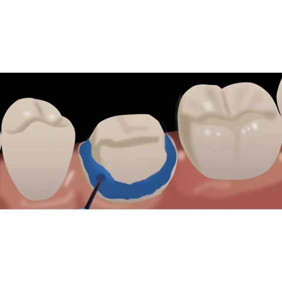 indirect restoration dispensing porcelain etchant step 5