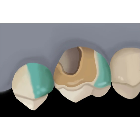 Intraoral Repair with z prime step 3