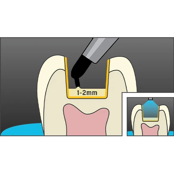 posterior composite quantium technique 3