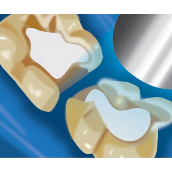 Indirect Pulp Capping - TheraCal LC Step 3