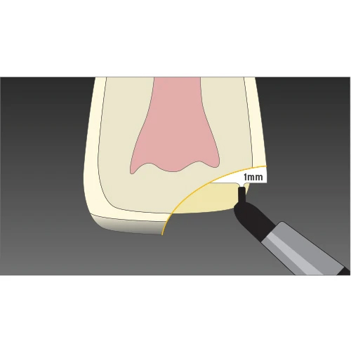 anterior composite restorations step 4