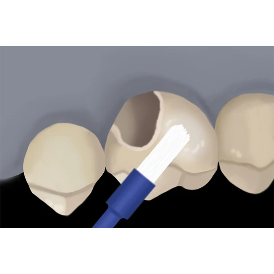 Intraoral Repair with z prime step 3