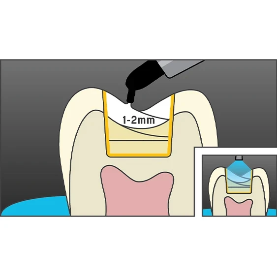 posterior composite quantium technique 4
