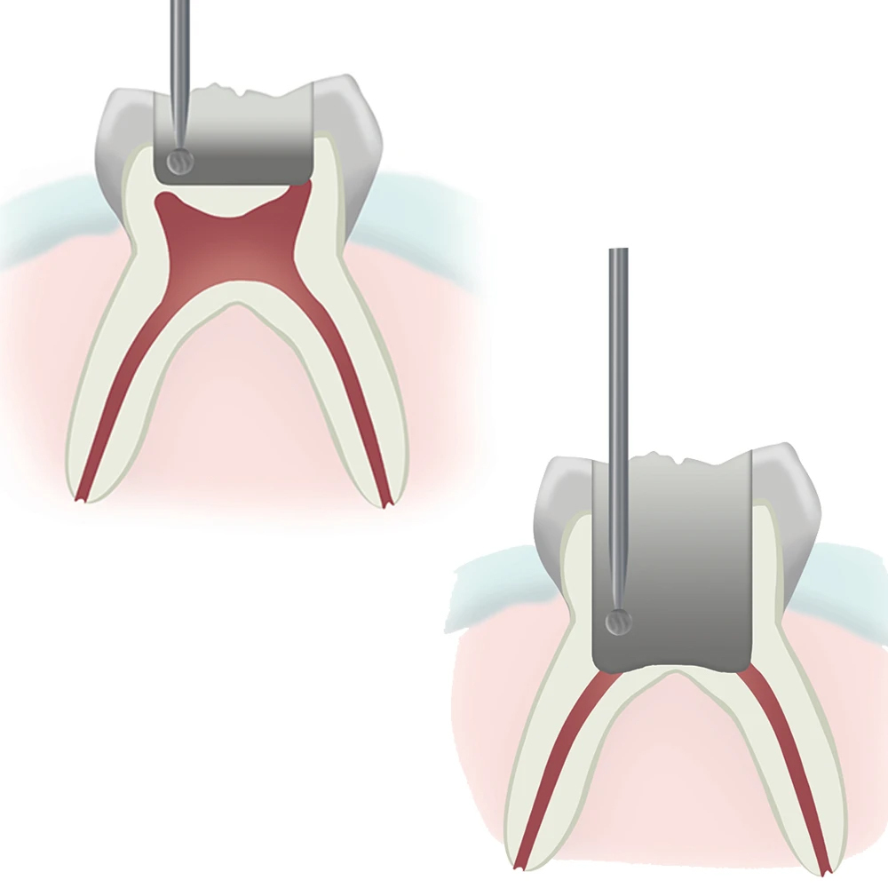 Pulpotomy Step 1