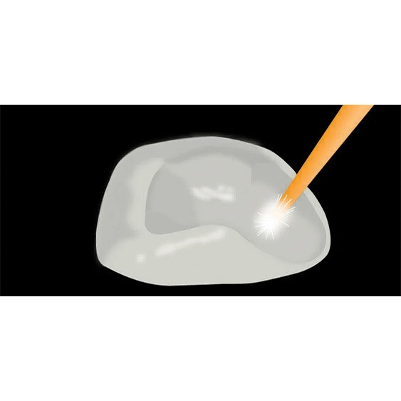 Veneer Cementation of Glass Ceramics Step 8