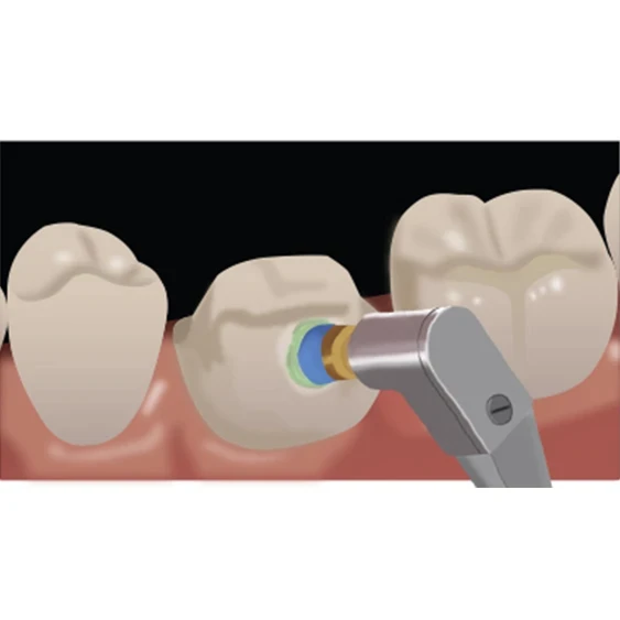 indirect restoration tooth crown step 2