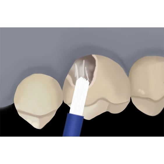 Intraoral Repair with z prime step 3