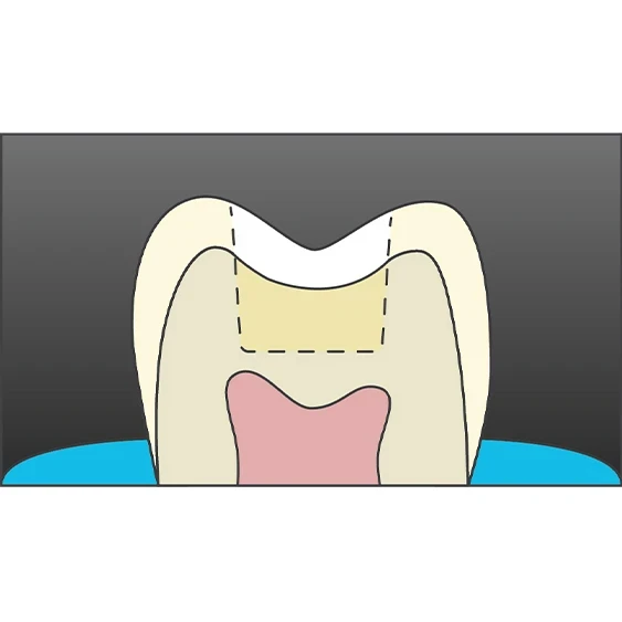 posterior composite quantium technique 5