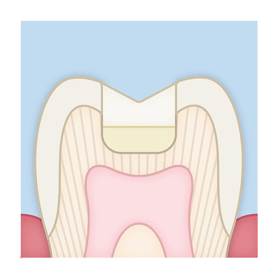 theracem sandwich tech 5