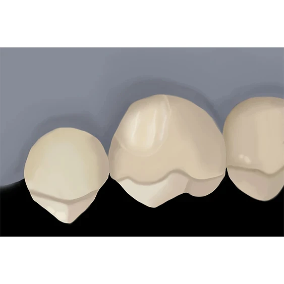 Intraoral Repair with z prime step 3