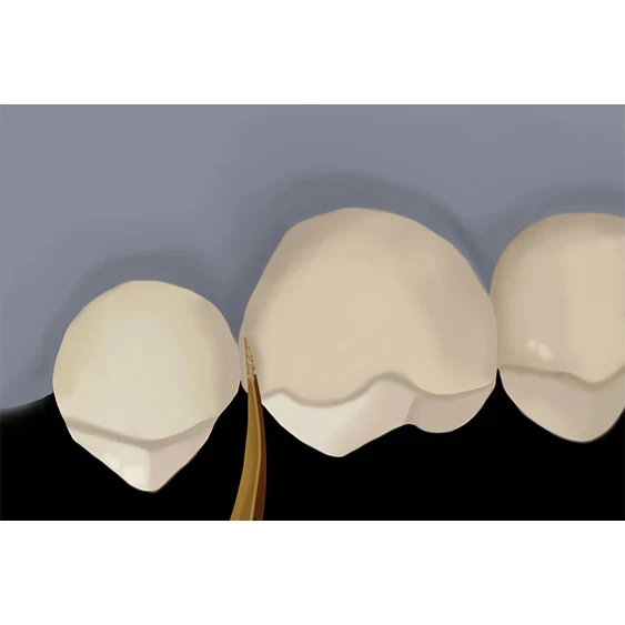 Intraoral Repair with z prime step 3