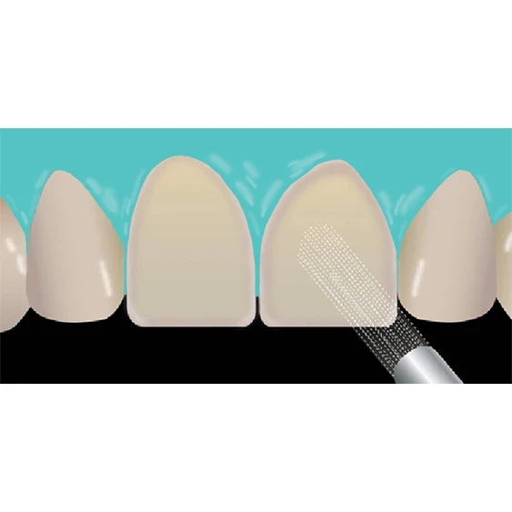 Veneer Cementation of Glass Ceramics Step 6