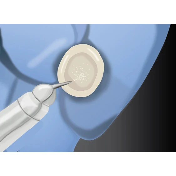 indirect restoration tooth crown step 1