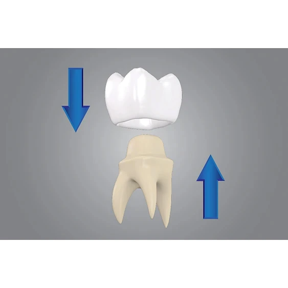 Self-Adhesive Cementation of Zirconia or Metal step 3