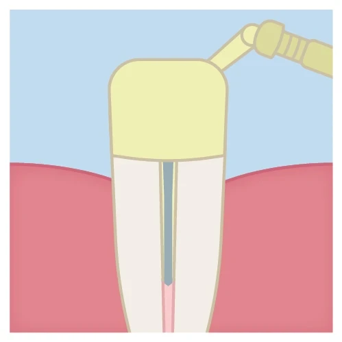 post cementation technique step 8