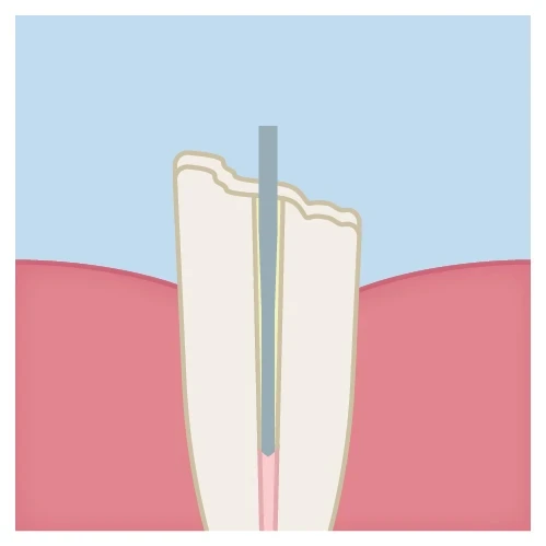 post cementation technique step 7