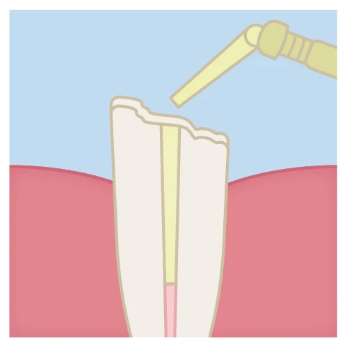 post cementation technique step 6