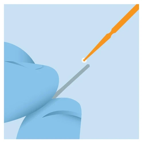 post cementation technique step 5