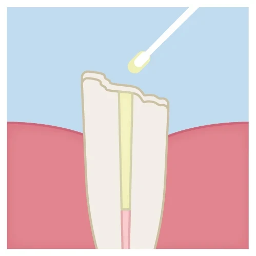 post cementation technique step 4