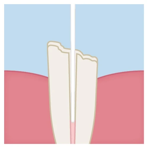 post cementation technique step 2