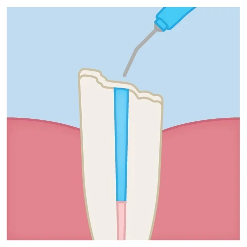 post cementation technique step 1