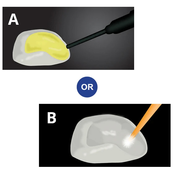 veneer-cementation-first-step-1-or-b