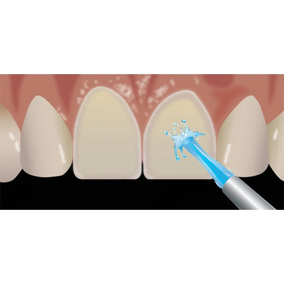 veneer-cementation step 2