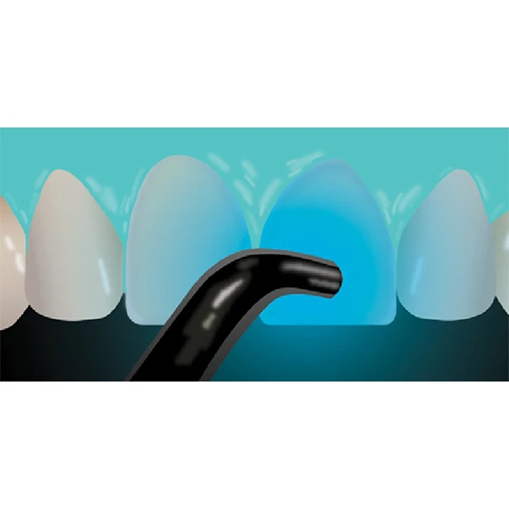 veneer-cementation step 7