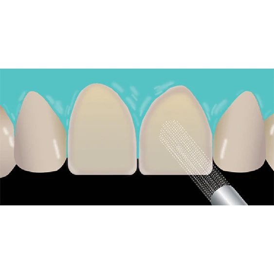 veneer-cementation step 6