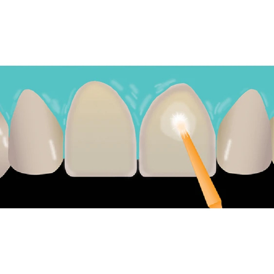 veneer-cementation step 5
