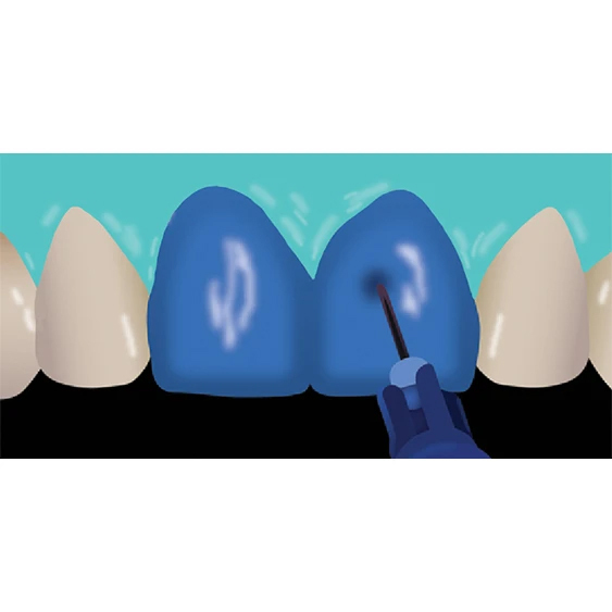 veneer-cementation step 4