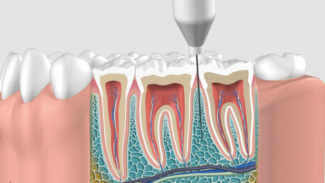 Prednosti intraosealne anestezije: Zašto odabrati QuickSleeper5 za bezbolne stomatološke zahvate