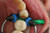 G-Wedge™ Set interproksimalnih klinova (100 kom. svake boje)