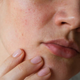 To treat a skin condition, you must first repair the skin barrier