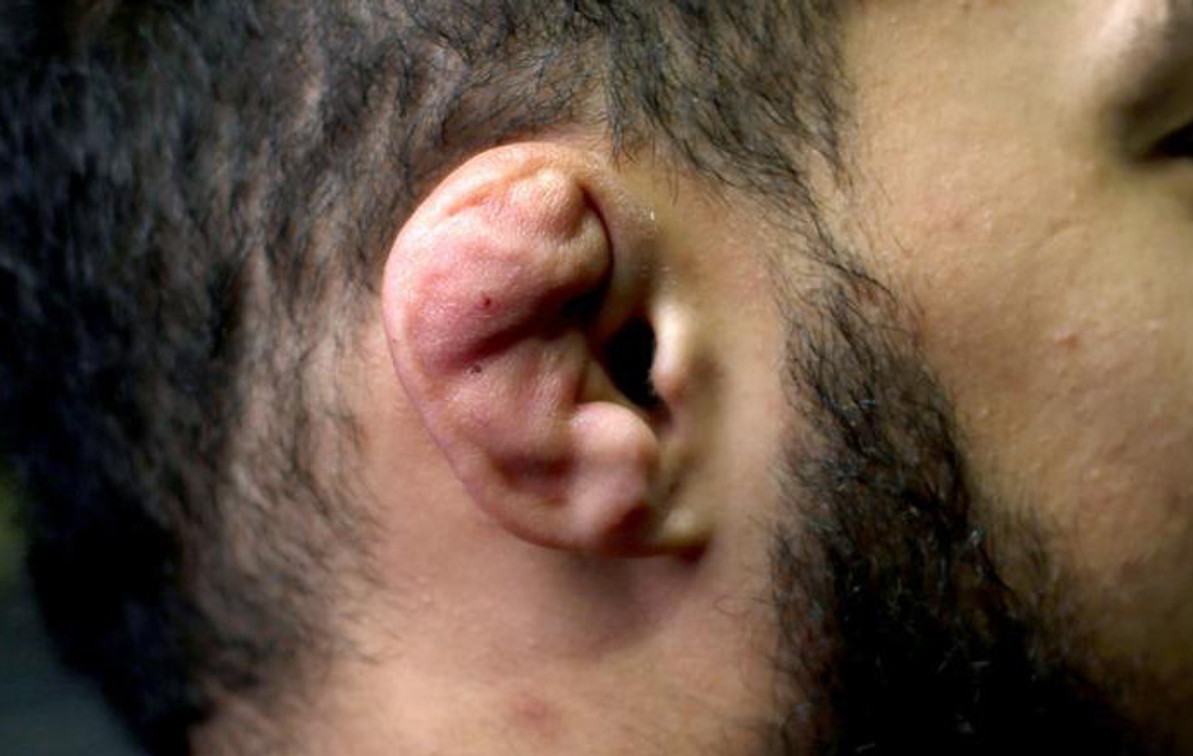 cauliflower ear