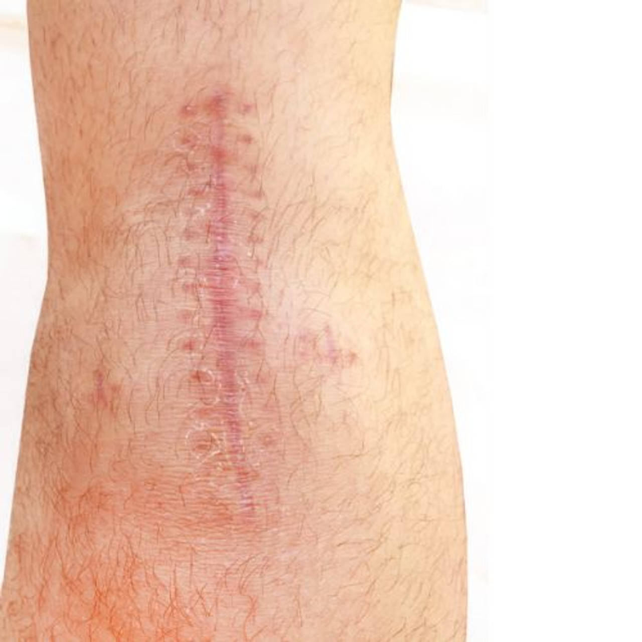 SCAR TISSUE & MASSAGE (2 CEUs) SCAR TISSUE & MASSAGE (2 CEUs)