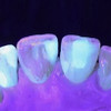 Microlux DW Transilluminator | Diagnose micro-leakage, white spot lesions, and demineralization.