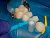 Cure Through Wedge Wands® Refill