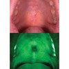 Five violet, high-power LEDs and special optical filters cause abnormal cells to appear as dark areas among the bright fluorescence of surrounding healthy tissue