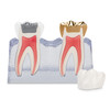 402818 | Pre/Post Treatment Cracked Tooth Model | Cracked tooth treatment model eases communication.