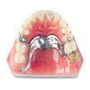 4056810 | CB-10 Restoration Model | The upper arch model features life-sized pink gingiva with eight removable restorations and a transparent implant window.