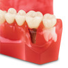 4071918 | 7-Unit Implant Crown and Bridge Model