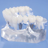 4071920 | Transparent Implant Crown and Bridge Model