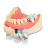 7017143 | Palodent 360 Circumferential Matrix System 48/Box | In 4.5mm, 5.5mm, or 6.5mm sizes.