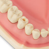 SilverPlug | Conical shape allows a perfect fit into any tunnel diameter on screw retained crowns, abutments, and Toronto bridges.