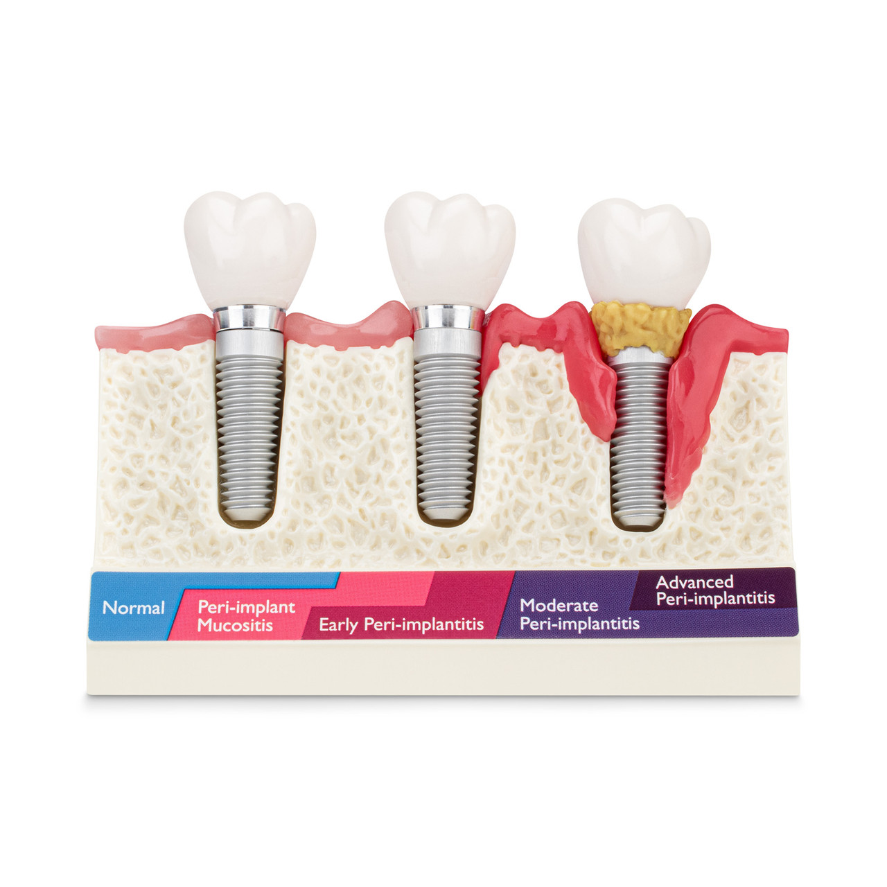 Peri-Implant Disease Model | Practicon, Inc