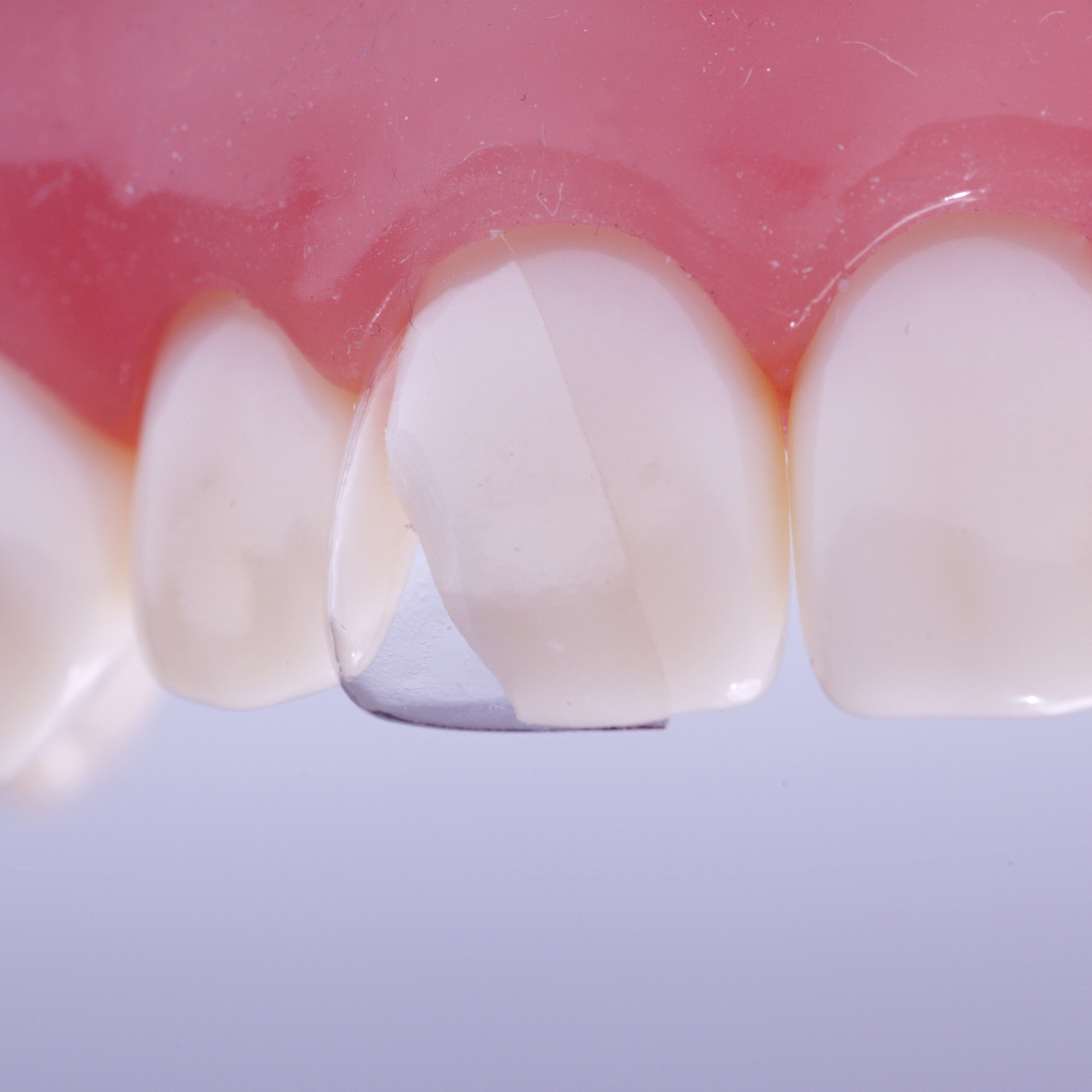 Matrici cervicali trasparenti Hawe KERR Ng851S