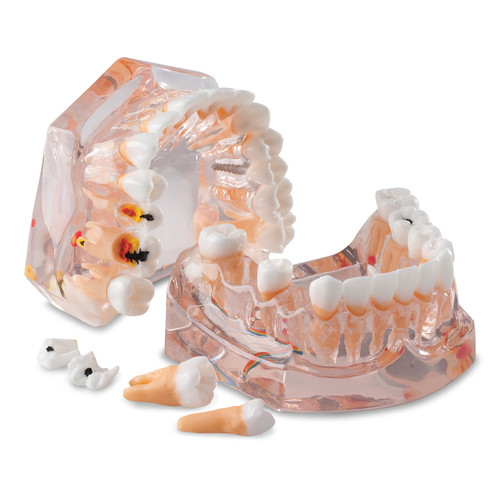 Enlarged Model For Hygiene And Caries Evolution