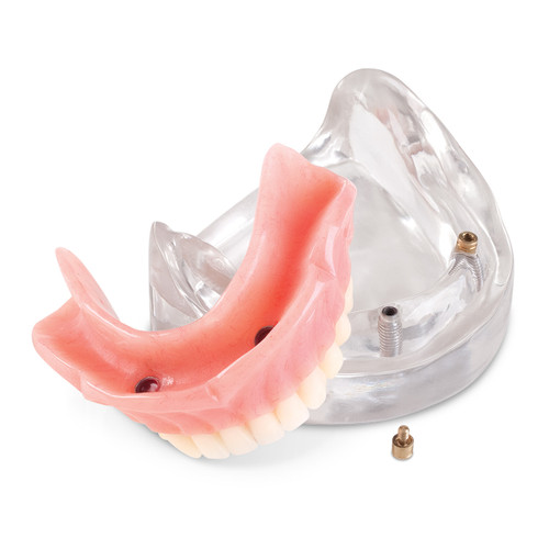 LOC-2 Lower Locator Two Implant Model