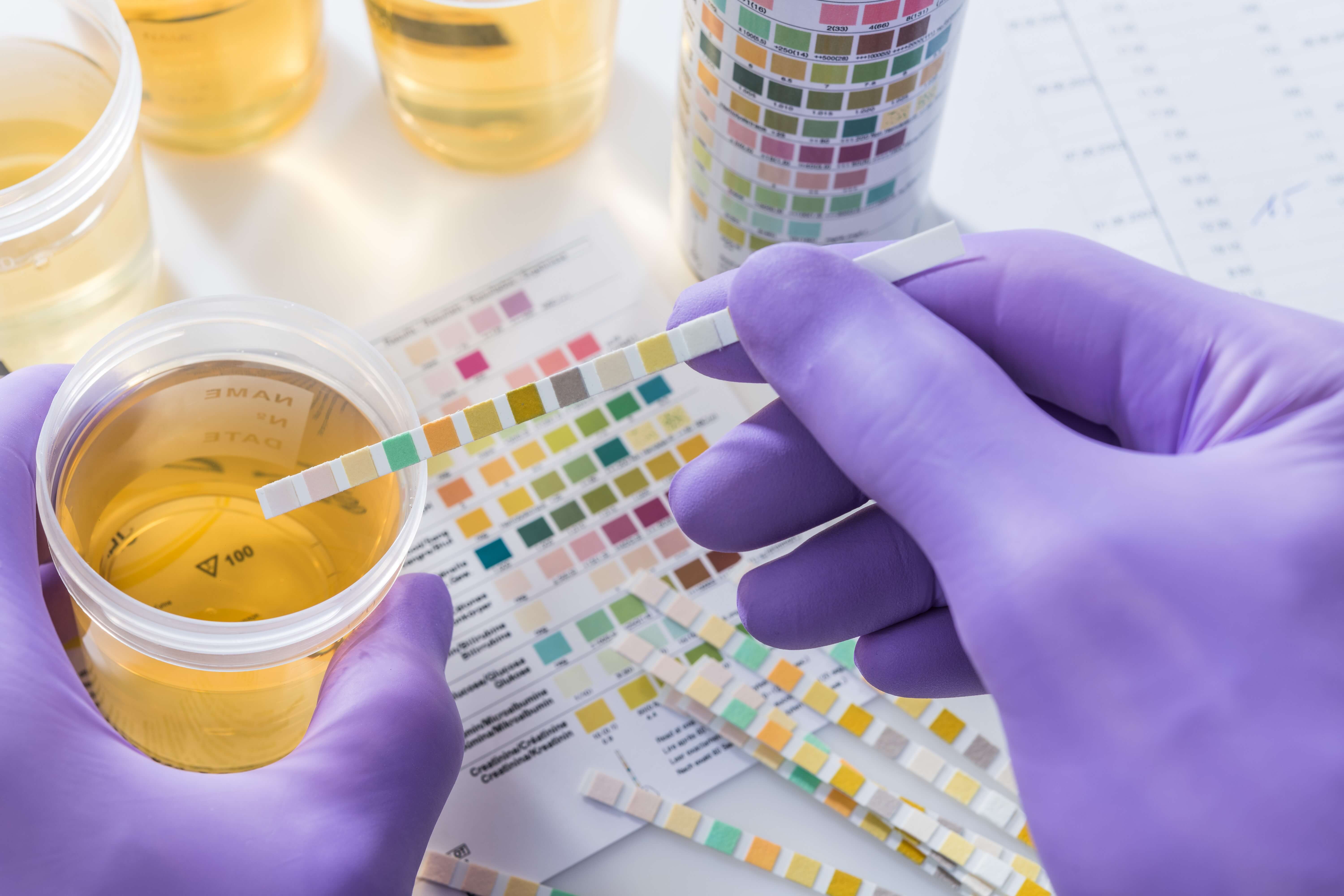 Doctor examining a urine sample
